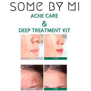 SOME BY MI Miracle Acne Care Set - Soap + Toner + Serum + Cream - Skin Type Oily and Acne Prone Skin.